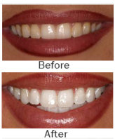 Whitening