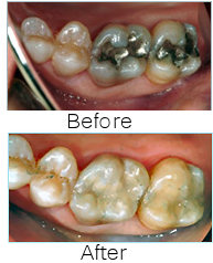 Tooth Colored Restorations