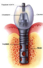 Dental Implants