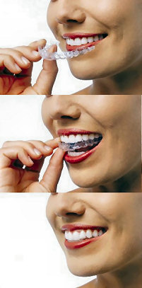 Invisalign